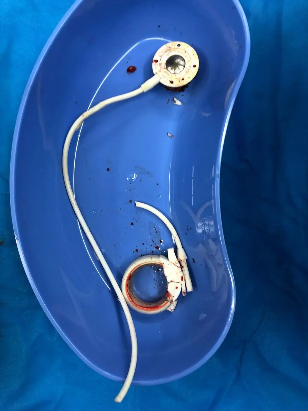 Lap Band Removal Before Gastric Bypass